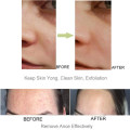 Mascarilla facial de arcilla de aguacate natural Mascarilla de limpieza profunda de poros para la piel Mascarillas de eliminación de espinillas con acné